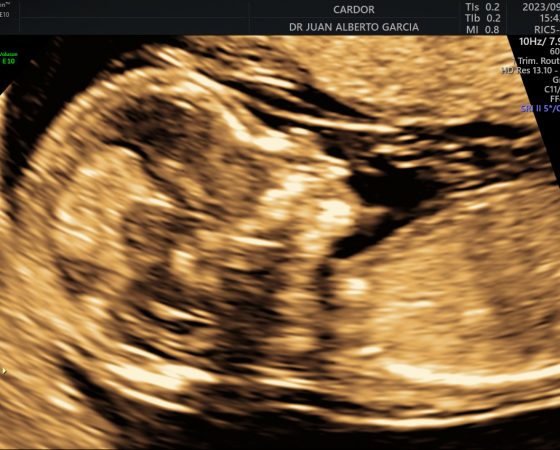 Perfil Fetal 2D 18 semanas