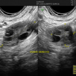 Ecografía Transvaginal + AFC (Recuento Antral Folicular)